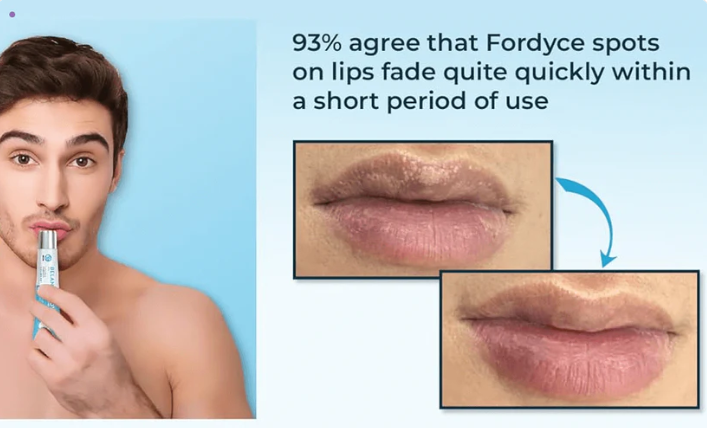 💋 Fordyce Clean Pro – Deshazte de las imperfecciones labiales 💋
